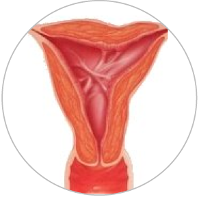 Aderente intrauterine (sinechii uterine)