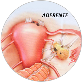 Infertilitatea poate fi secundara aderentelor