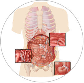 Aderentele pot bloca tranzitul intestinal