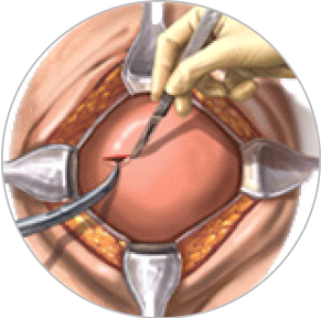 Incizia uterului (histerotomie)