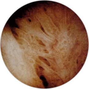 Sinechii uterine - imagine histeroscopica